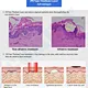 Fractional Thulium Laser